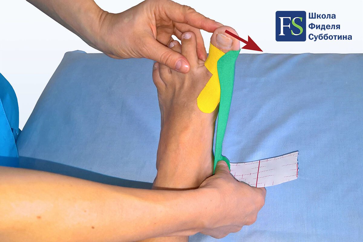 Статодинамическое тейпирование стопы при Халюс Вальгус (Hallux Valgus) - 5 Статодинамическое тейпирование стопы при Халюс Вальгус (Hallux Valgus) - 5