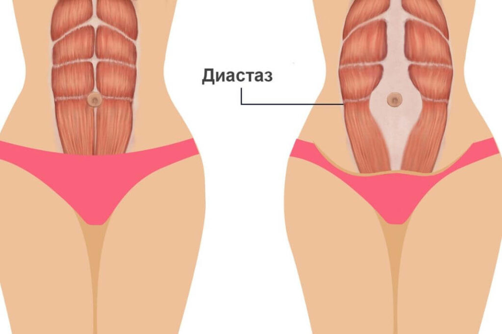 диастаз прямых мышц живота диастаз прямых мышц живота